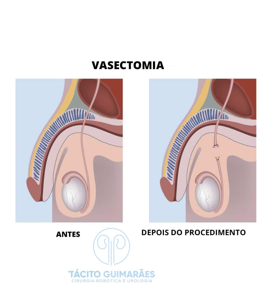 Os principias cuidados e orientações após uma vasectomia