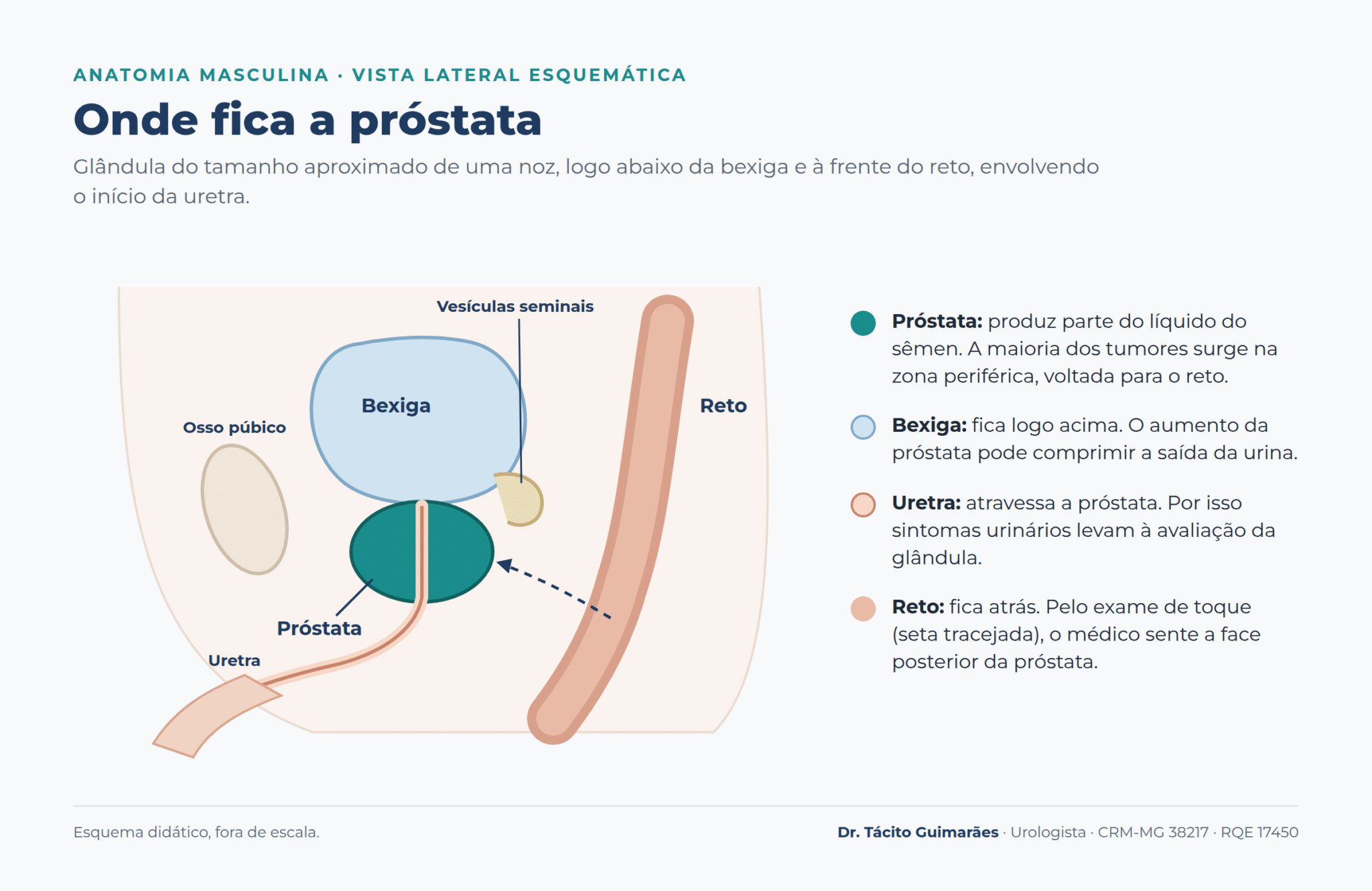 Esquema da anatomia masculina mostrando a próstata abaixo da bexiga e à frente do reto